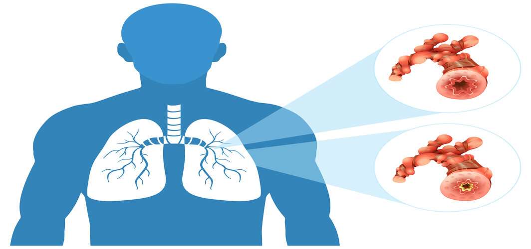 What Are The Common Chronic Lung Diseases?