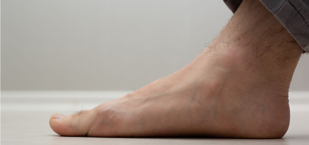 Should You Worry If You Have Flat Feet?