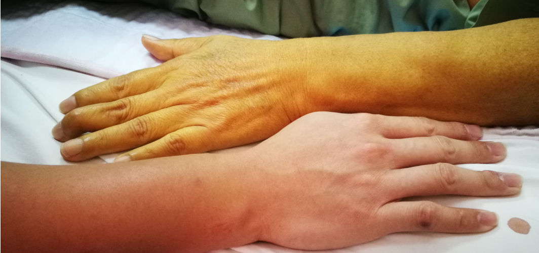 Adult Jaundice Early Signs to Look out For