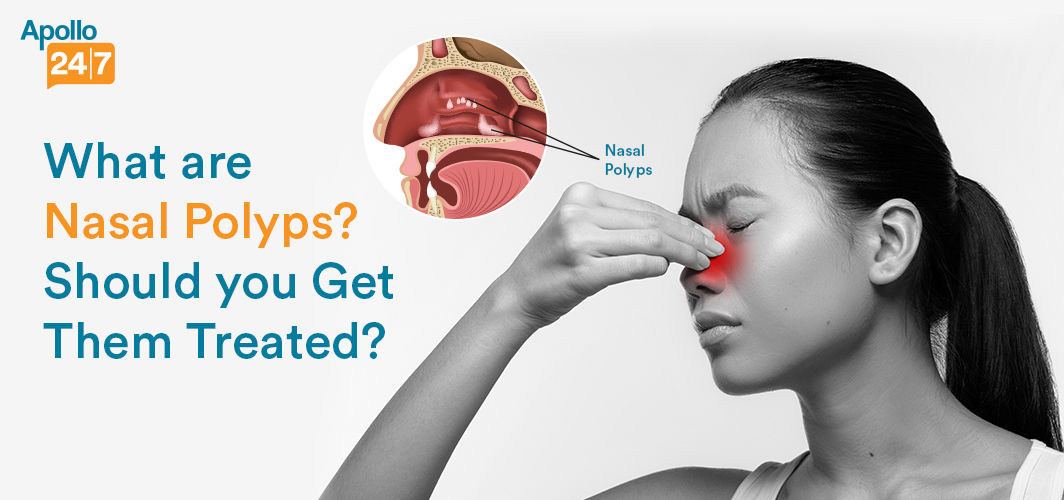 What Are Nasal Polyps Should You Get Them Treated