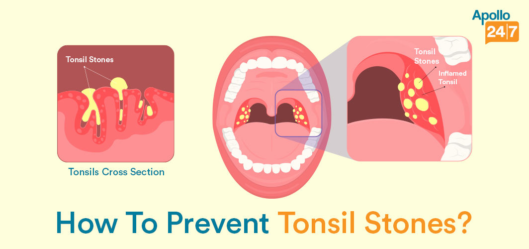 tonsils stones