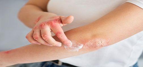 skin-rashes-causes-symptoms-red-flags-and-treatment