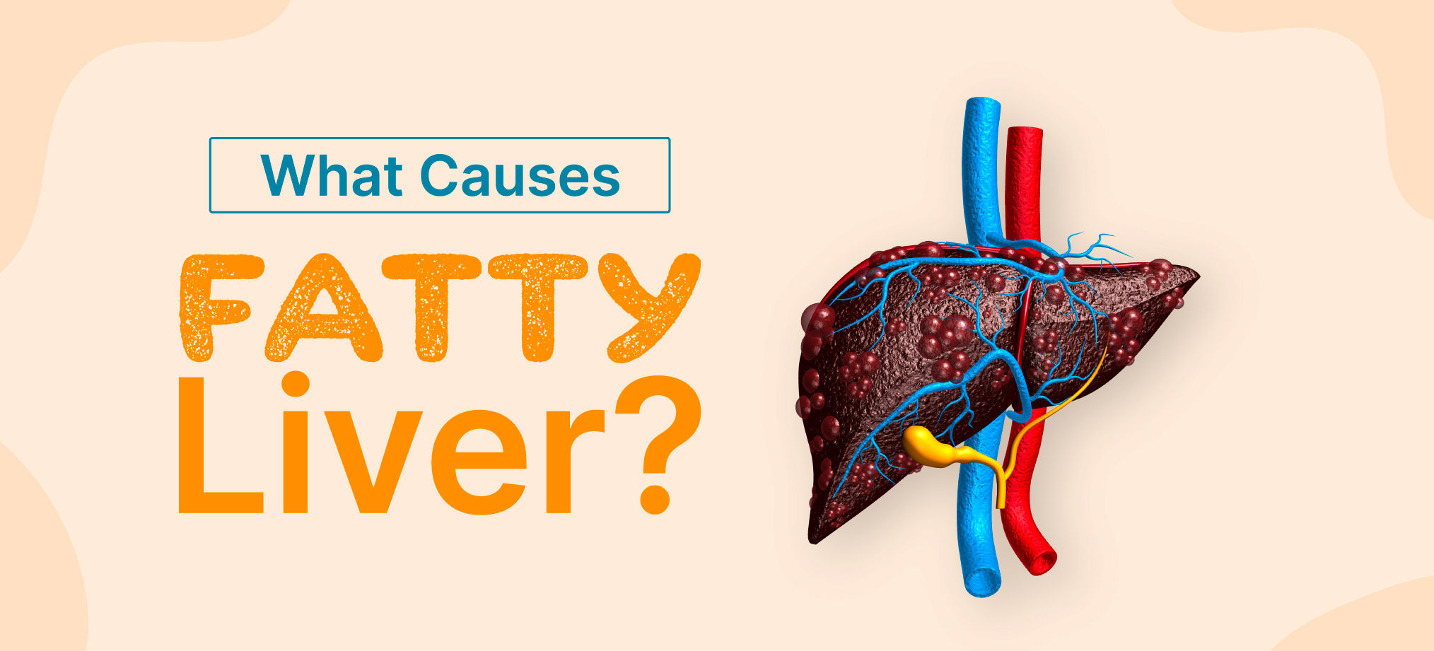 Fatty Liver: What Is to Be Blamed, Fats or Carbs?