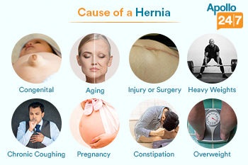 Causes-of-hernia
