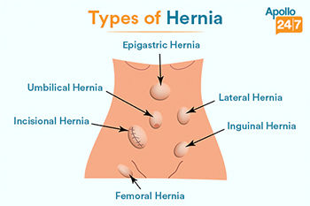 Hernia Pictures of 6 Common Types