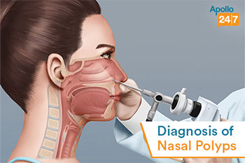 nasal polyps surgery