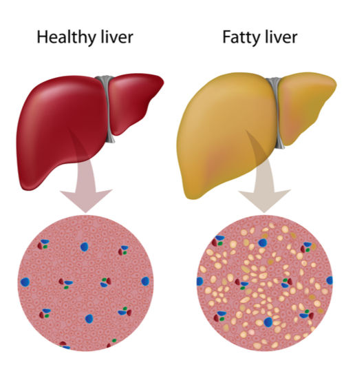 Fatty Liver