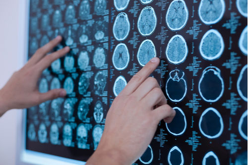 MRI