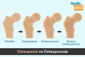 difference-between-osteoporosis-and-osteopenia