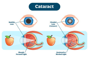 cataract