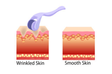 derma roller