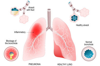 bronchopneumonia in children