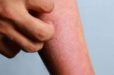 eczema