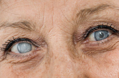 cataract