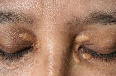 cholesterol bumps on eyelids