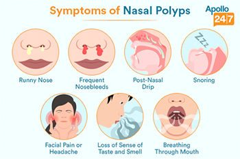 Nasal-polyps-symptoms