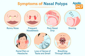 Symptoms of online sinus polyps