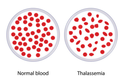 Thalassemia-blood-sample