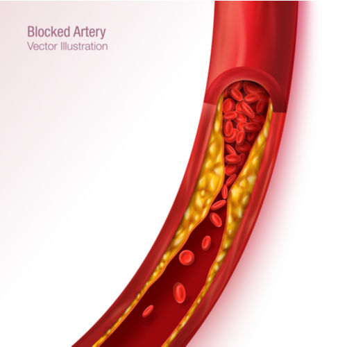 blocked_Arteries