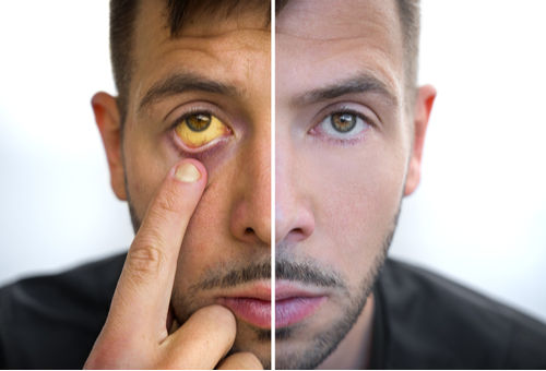 jaundice