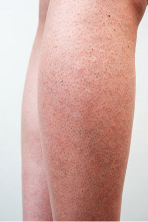 keratosis