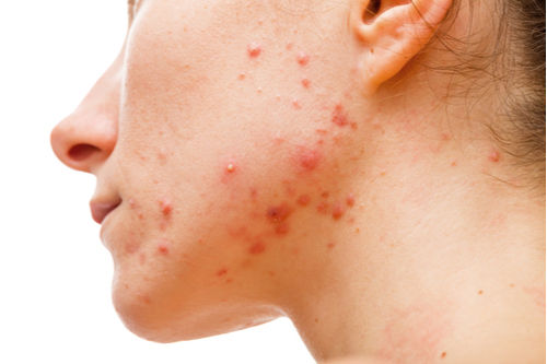 monkeypox_symptoms