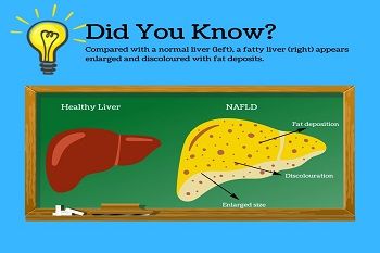 Non-alcoholic-fatty-liver