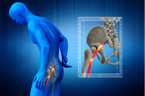 Spinal Stenosis is a common cause of low back pain and sciatica - Capitol  Pain Institute