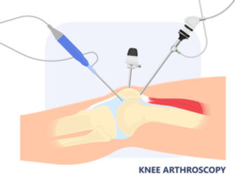 arthroscopy