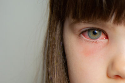 conjunctivitis