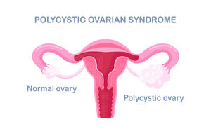 pcos