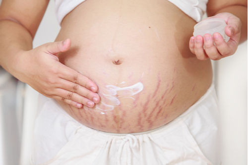 stretch_marks_pregnancy